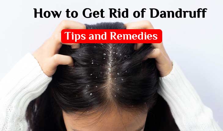 How to Get Rid of Dandruff