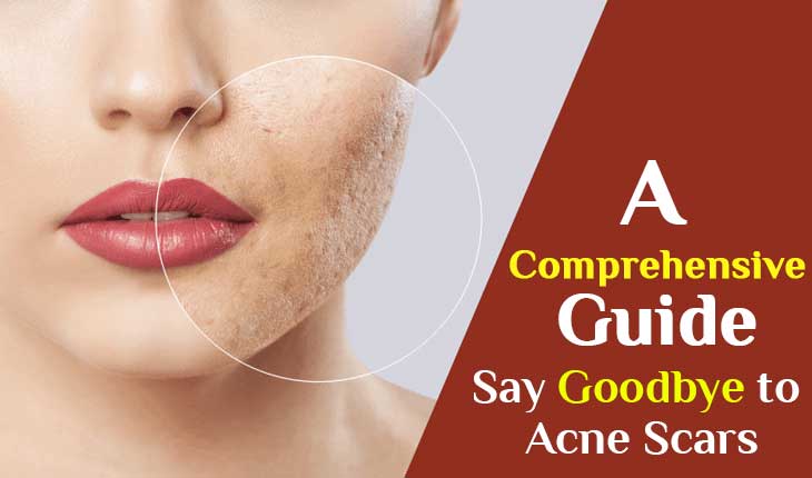 Say Goodbye To Acne Scars A Comprehensive Guide Explain Here 3474